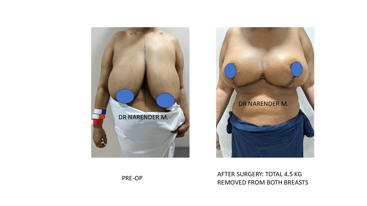 Breast Reconstruction Photo 1